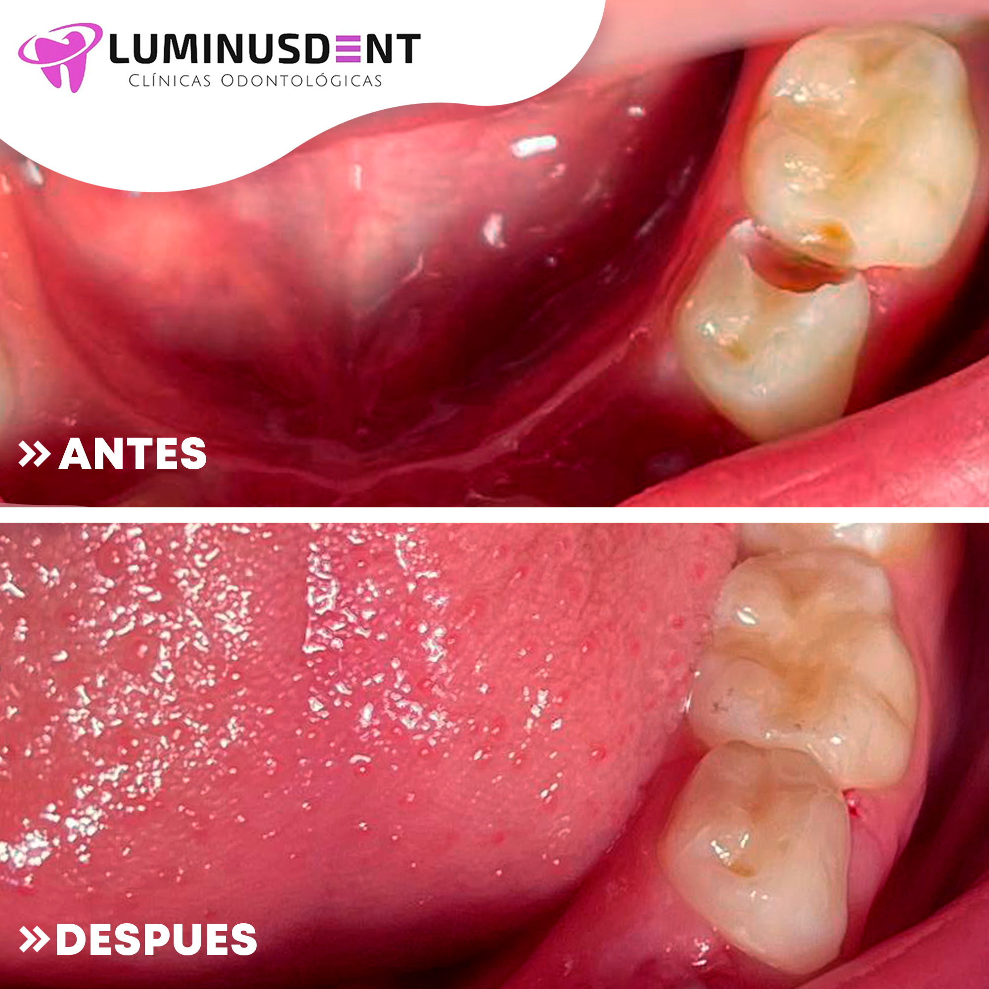 antes y despues caries niños