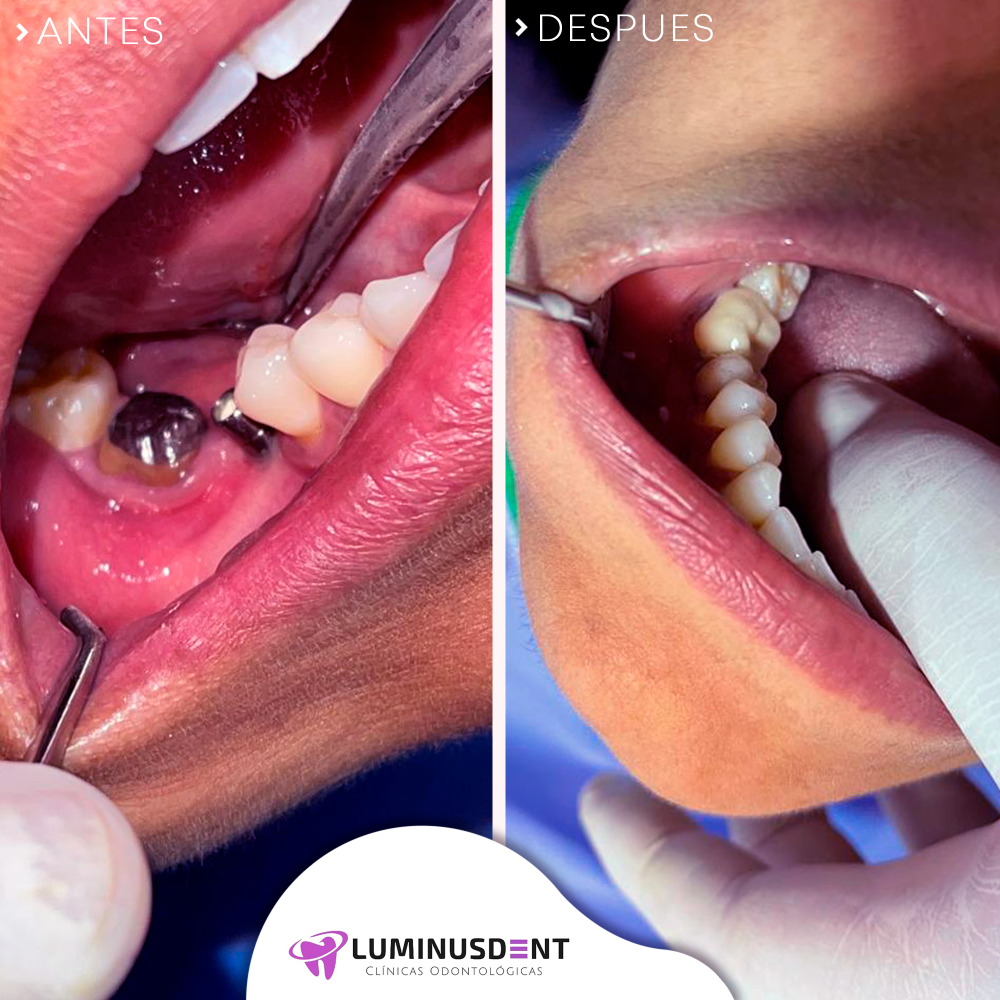 antes y despues coronas dentales