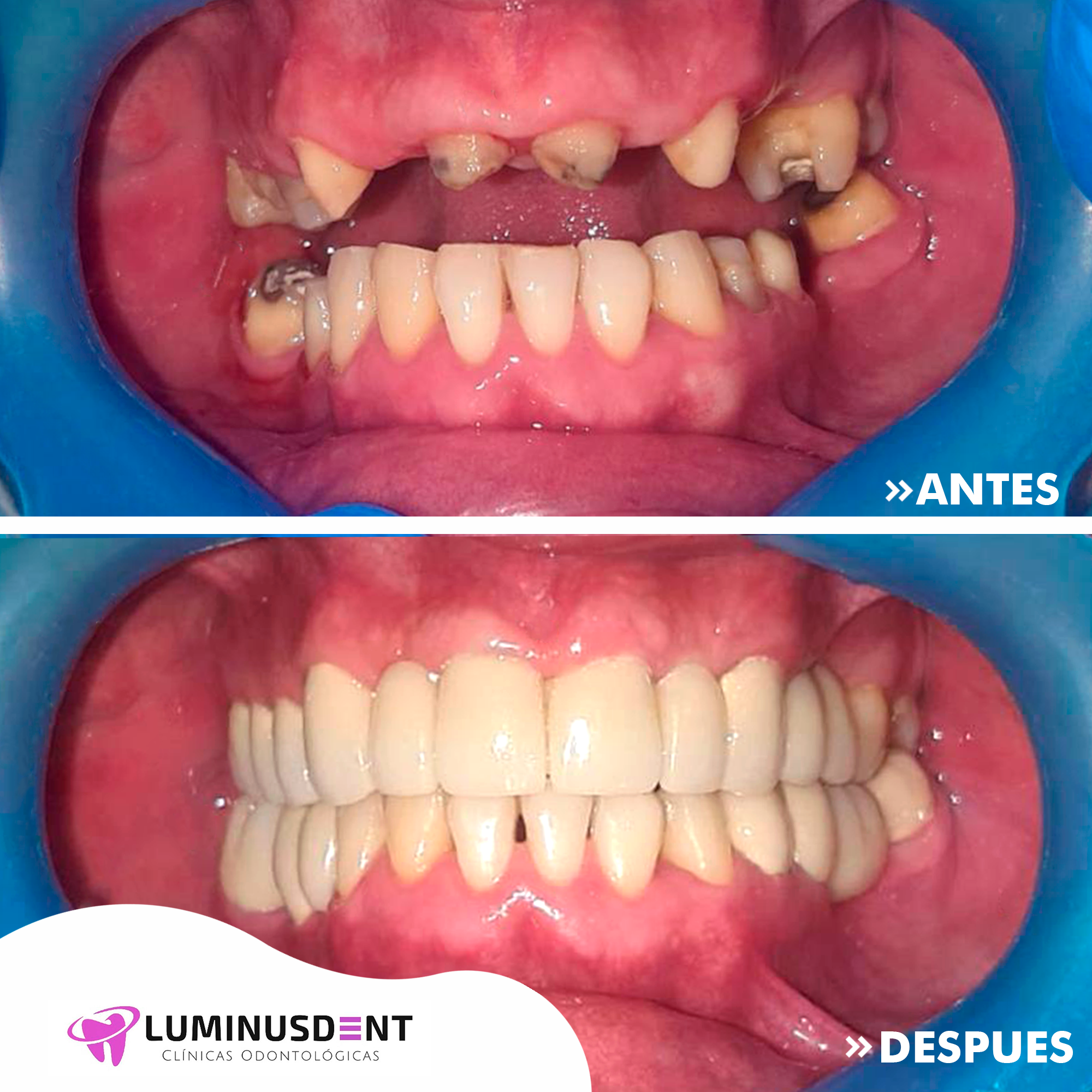antes y despues mayo 31