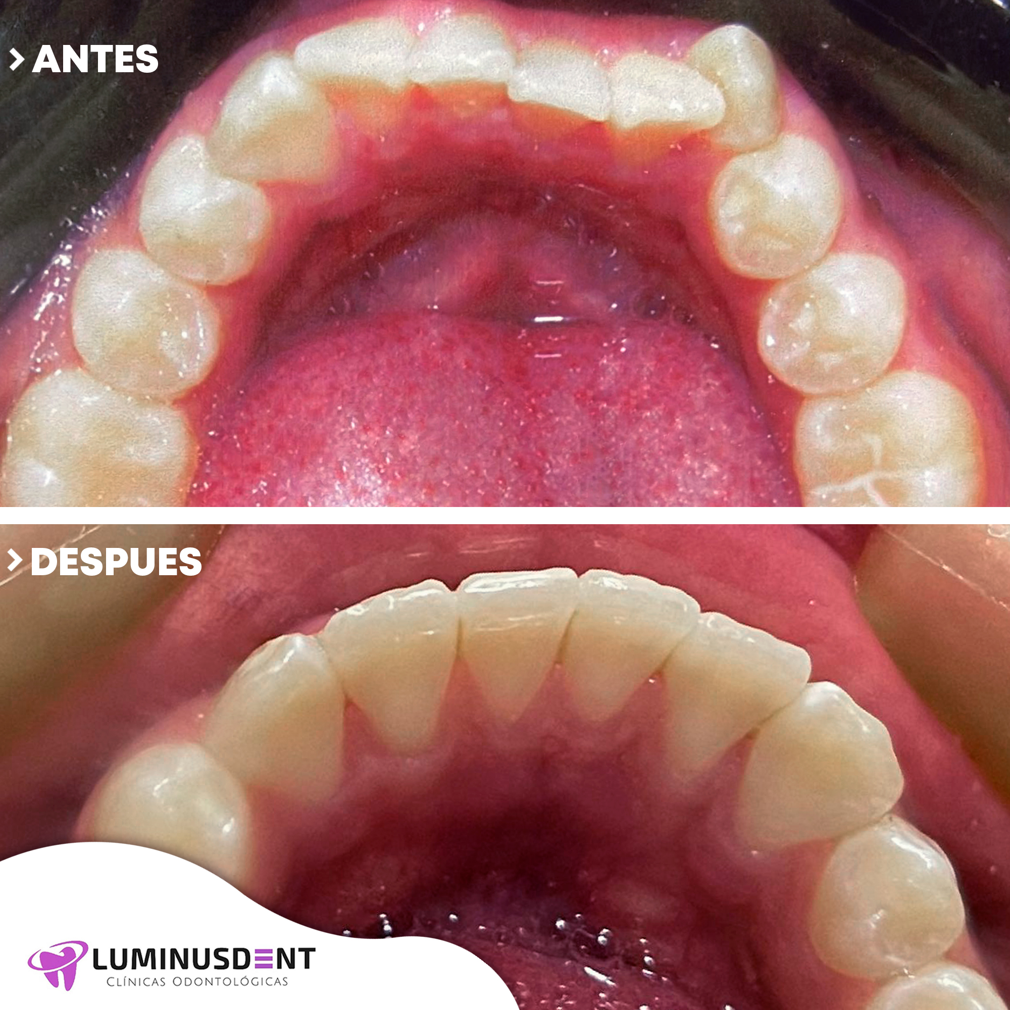 antes y despues ortodoncia 2