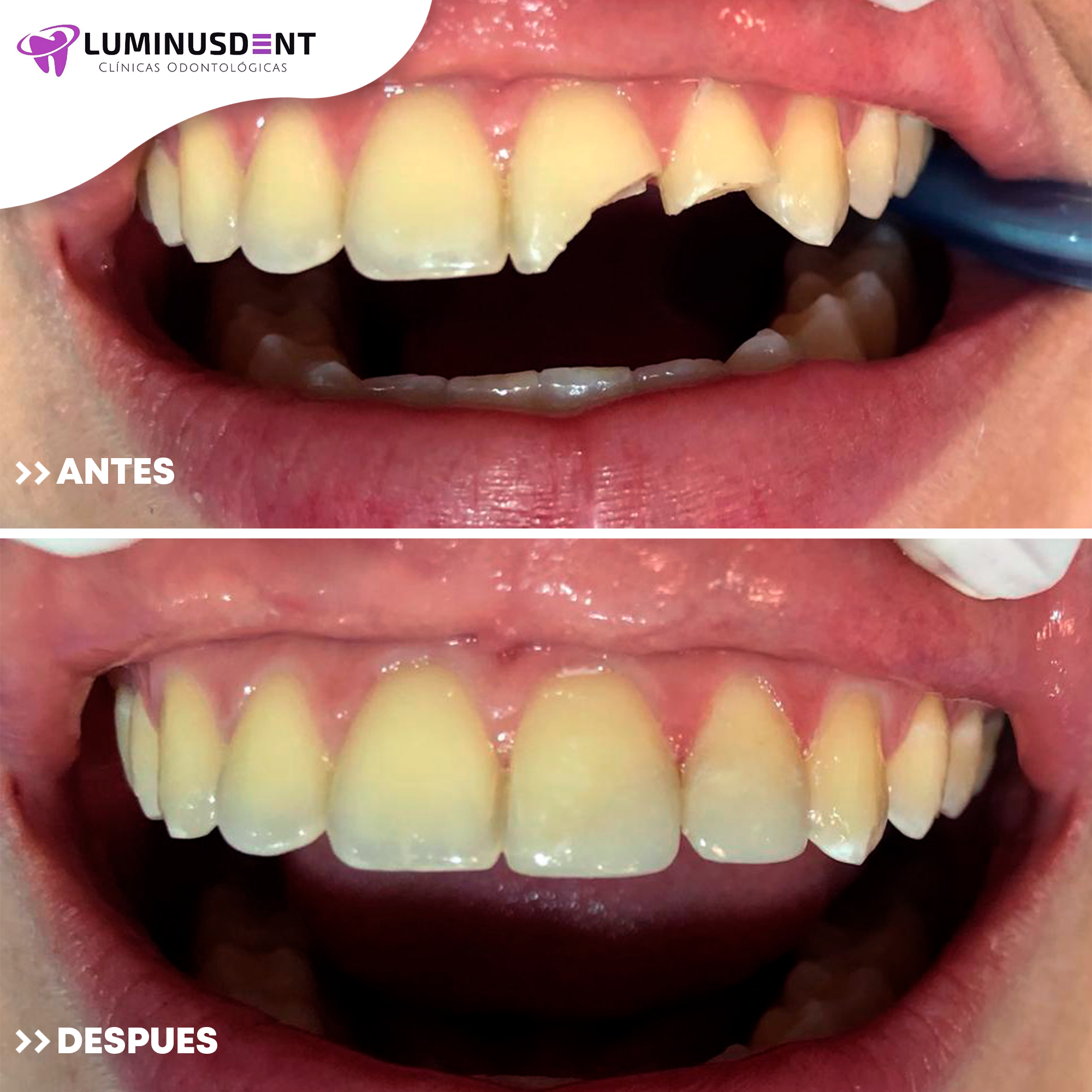 luminusdent antes y despues carillas